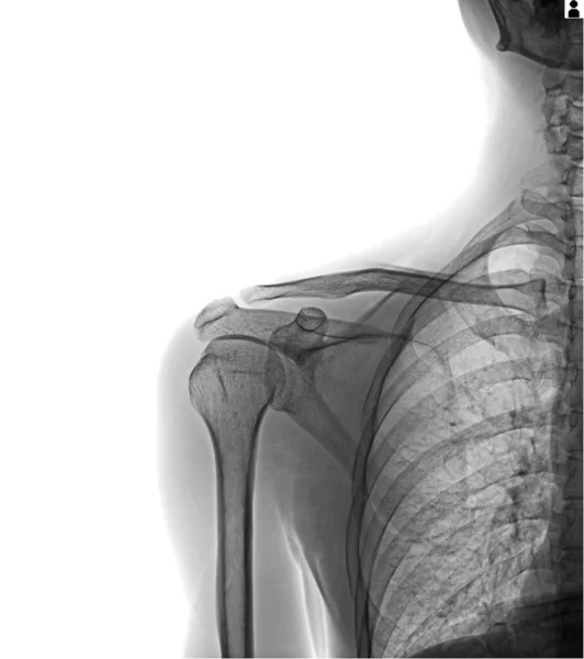 人間の骨折と人間の腕の線 — ストック写真