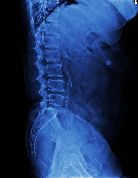 Ray Spine Patient — Stock Photo, Image