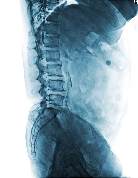 Ray Image Spine Spine — Stock Photo, Image