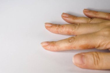 Çok fazla el yıkama, sabun veya alkol jeliyle dezenfekte ve covid-19 salgını sırasında sprey sıkma, daha az nemli, soyulmuş ve kuru cilt sorunlarına yol açıyor.