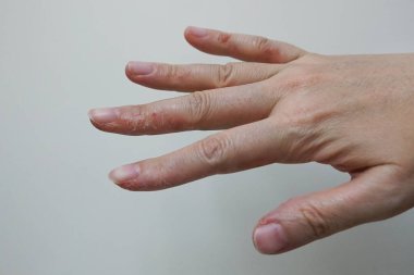 Çok fazla el yıkama, sabun veya alkol jeliyle dezenfekte ve covid-19 salgını sırasında sprey sıkma, daha az nemli, soyulmuş ve kuru cilt sorunlarına yol açıyor.