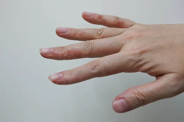 Cracked skin on finger after too much washing hand and sanitization with soap or alcohol gel and spray during covid-19 pandemic, causing skin problems with less moisture, peeled and dry skin