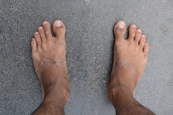 İki kuru, pürüzlü ve hafif yaralı ayağın yakın çekimi gri betonun üzerinde duruyor. Ayak derisi sorunları veya sağlık sorunları.