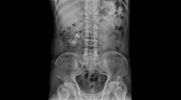 Photo Plain Radiograph Dark Background Hospital Film Use Diagnosis Illness — Stock Photo, Image