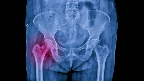 Non Displace Fracture Femoral Neck Osteoporosis Woman — Stock Photo, Image