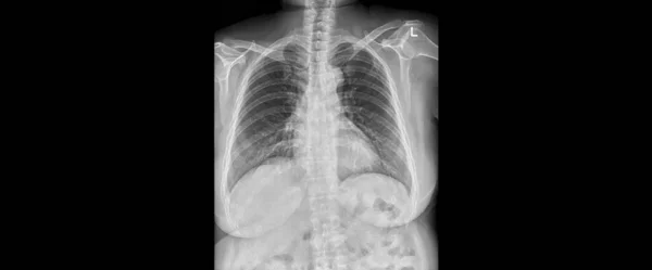 Plain Radiograph Dark Background Hospital Film Use Diagnosis Illness Patient — Stock Photo, Image
