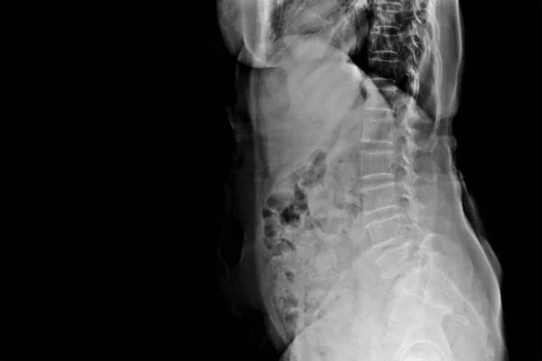 Photo of plain radiograph on dark background in hospital. The film use for diagnosis the illness of patient.Medical concept.Spondylolithesis of L5/S1 level in osteoporosis patient with back pain.