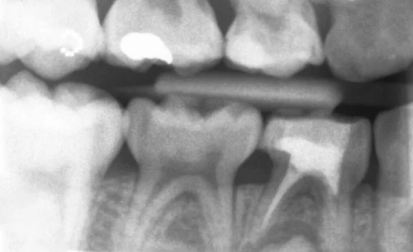 Black White Image Dental Ray Adult Dental Implant Roentgen Teeth — Stock Photo, Image