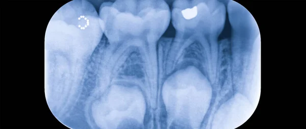 Black White Image Dental Ray Adult Dental Implant Roentgen Teeth — Stock Photo, Image