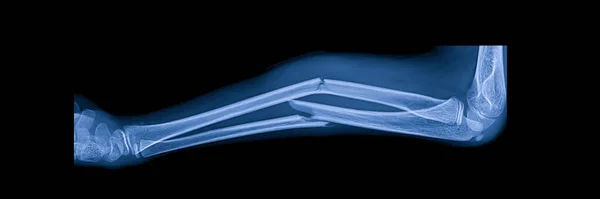 Plain radiograph on dark background in hospital.The xray use for diagnosis of the illness of patient.Medical concept.Blue tone of x-ray showed greenstick fracture of both bone forearm.Radius and ulnar