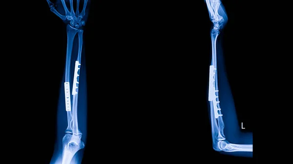 Plain radiograph on dark background in hospital.The x-ray is used for diagnosis of the illness of patient.Medical concept.Forearm fracture with compression plate.Fixation of fracture in blue tone.