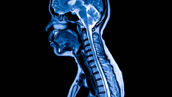 Blue tone radiograph on dark background in hospital.Doctor used MRI to diagnosis the illness of patient.MRI of human spine in sagittal or lateral view.Diagnosis of spine metastasis with back pain.