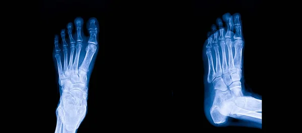 Blue tone radiograph on dark background in hospital.Doctor used xray for diagnosis of the illness of a patient.X-ray of Foot AP and oblique.Normal study.Diagnosis of foot pain, and plantar heel pain.