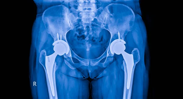 Blue tone radiograph on dark background in hospital.Doctor used xray for diagnosis of the illness of patient.Total hip joint arthroplasty both hip with medical implants in orthopedic unit by surgeon.