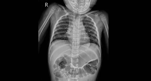 Radiograph on dark background in hospital.Doctor used xray for diagnosis of the illness of patient.Chest X-ray of children with common cold or pneumonia.Child health education.Normal x-ray in children