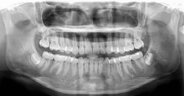 Panoramic dental Xray shows fixed teeth amalgam seal.X-ray for dental problems in toothache patient or trauma patient after accident for diagnosis of mandible fracture.Dental unit in hospital.