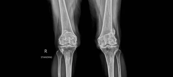 Radiograph on black background in hospital.Doctor used xray for diagnosis of the illness of patient.X-ray of osteoarthritis or oa of knee.Xray shows osteophyte and loose body with knee joint narrow.