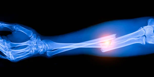 Blå Tonröntgen Bakgrunden Sjukhuset Läkaren Använde Röntgen För Diagnos Underarmsfraktur — Stockfoto