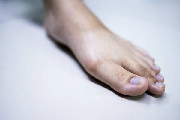 Ліва Нога Підлозі Показує Згусток Пацієнта Болем Стопі Вальгус Або — стокове фото