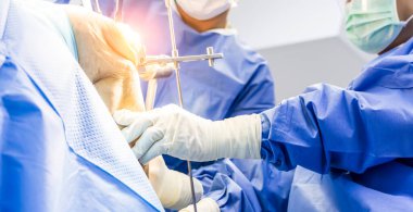 Osteomi sırasında ameliyat odasındaki mavi elbiseli doktor veya cerrahın eli. İnsanlar ortopedi bölümündeki diz eklemi ameliyatında protez eklem plastiği taktılar.