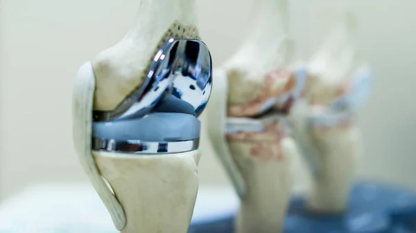 Knee joint prosthesis model in orthopedic education.Human skeleton model in total knee replacement surgery with blur background.Selective focus at polyethylene articular surface.Knee pain problem.