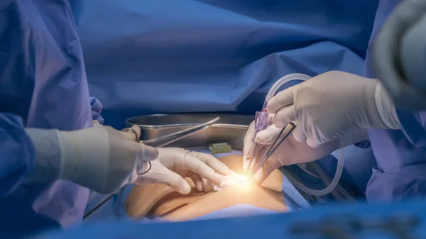 青いガウンの医師や外科医は 最小侵襲腹腔鏡手術で気胸を作るために腹部の空洞に空気を置きます 光で診断や胆管切除のための腹腔鏡技術の使用 — ストック写真