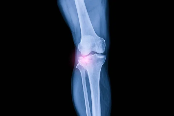 Колінний Рентгенівський Промінь Після Автомобільної Аварії Ортопедичному Відділенні Всередині Травматологічної — стокове фото