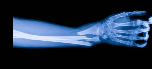 Рентгенівський Промінь Передпліччя Після Автокатастрофи Ортопедичному Відділенні Всередині Травматологічної Лікарні — стокове фото