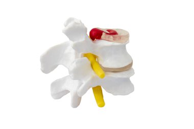Beyaz uzayın arka planında izole edilmiş anatomi modeli. Sırtı ve bacağı ağrıyan hastalarda fıtıklaşmış omurgalar arası diskle ilgili ortopedik cerrahi eğitimi. Beyaz iskelet ve HNP ile sarı sinir kökü..