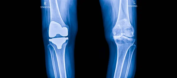 Синій Тон Рентгенівського Зображення Ортопедичному Апараті Всередині Лікарні Чорному Тлі — стокове фото