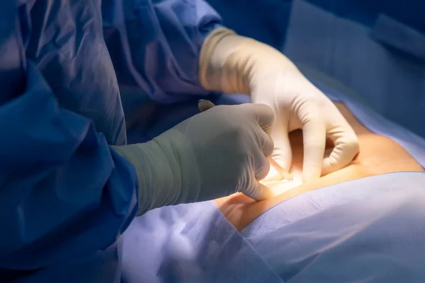 手术室里的外科医生或医生的手和手套 用手术灯的光技术 蓝色制服的人在腹部割伤 阑尾炎紧急病人接受手术 — 图库照片