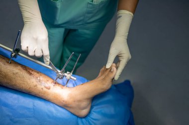Ortopedik hastalarda dış fiksatörü sıkılaştırmak için doktor ya da cerrahın eli. Ameliyat odasında beyaz bulanık arka planlı dış fiksasyon. Mavi perde..