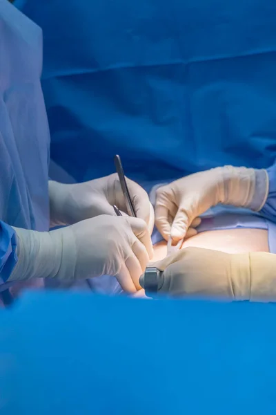 医師や外科医や看護師のチームは 病院の手術室内で虫垂切除手術を行いました 劇的な暗い背景を持つ青の制服の人々 手袋と楽器を持つ医療チーム — ストック写真