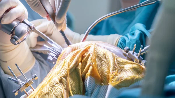 病院の手術室内の青いガウンを着た医師や外科医のチーム 外科医は膝関節置換手術技術を行いました 整形外科ユニットで見た医療との開胸 — ストック写真