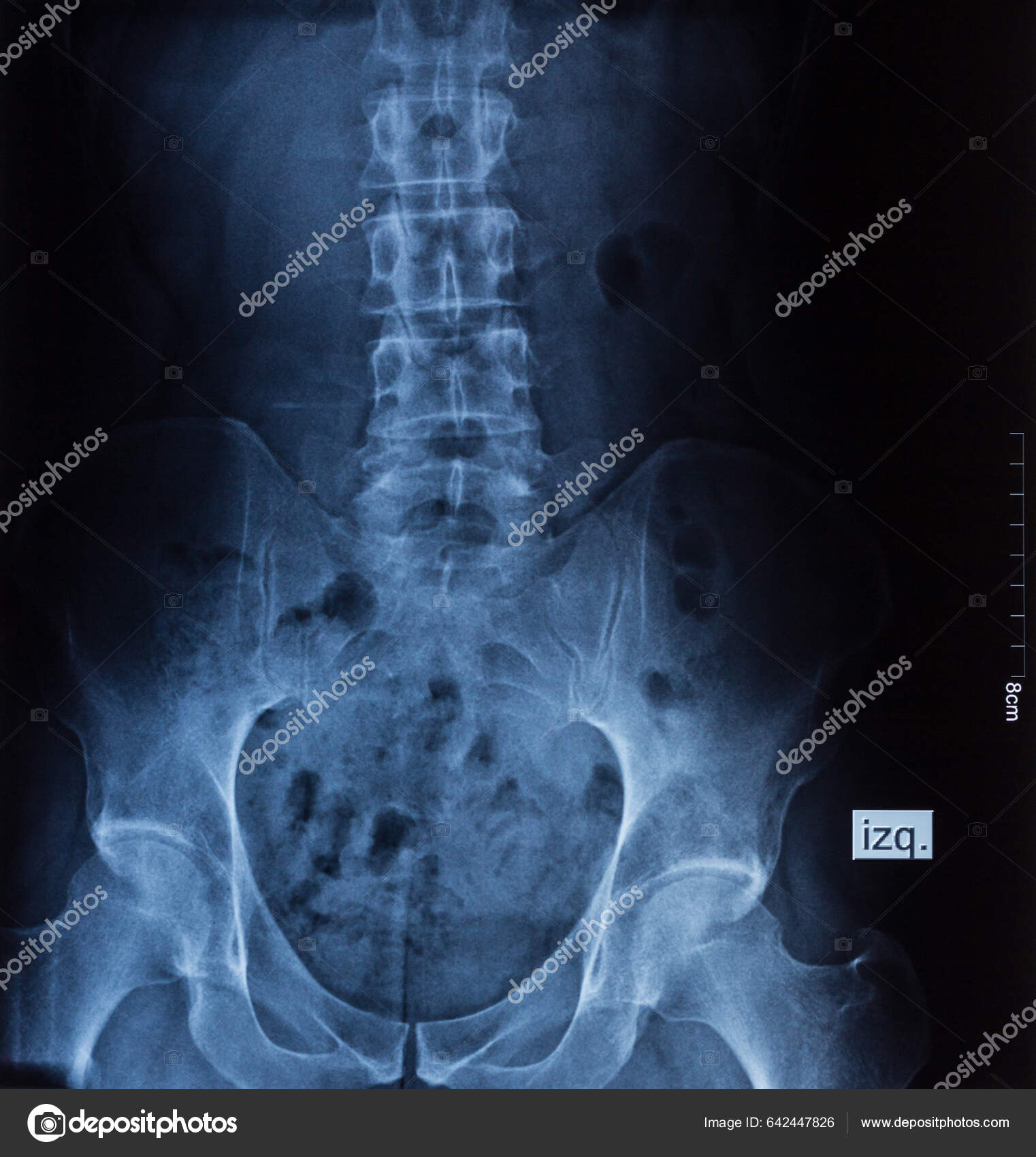 Coluna Vertebral Raio Cintura Radiografia Coluna Exame Médico Anatomia  Hospital — Foto © JosuOzkaritz #642447826, image size:1522x1700