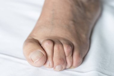 Ayak parmakları çekiç parmaklı ve beyaz arka planda kuru derili yaşlı bir adamın nasırı. Hijyen, ameliyat, sağlık, pediatrist, dermatoloji kavramları