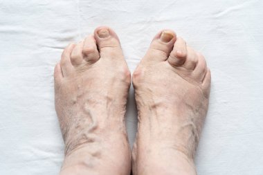 Kadın ayaklarının üst görüntüsü çekiç parmakları, kırık tırnaklar ve beyaz arka planda kuru deri. Hijyen, sağlık, sağlık, pediatrist, dermatoloji kavramları