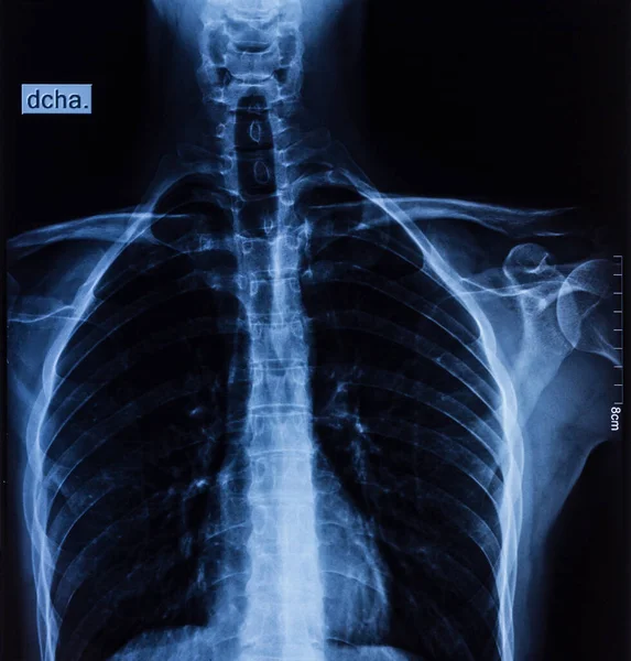 Akciğer Röntgeni Radyografi Bölümü Omurga Muayenesi Sağlık Hastane Ağrı Yaralanma — Stok fotoğraf