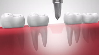 Dental implant in human denturra