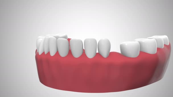 Dental Implant Gum — Vídeo de Stock