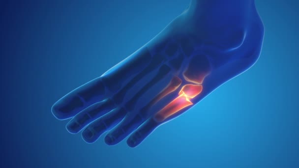 Fracture Foot Bone Pain Medical Concept — Stok video