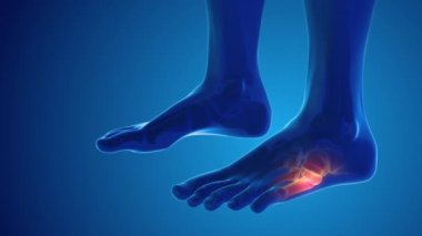 Broken foot bone pain medical concept