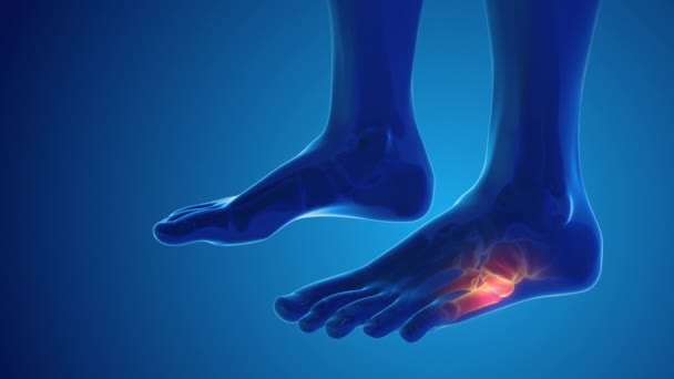 Broken Foot Bone Pain Medical Concept — Stok video