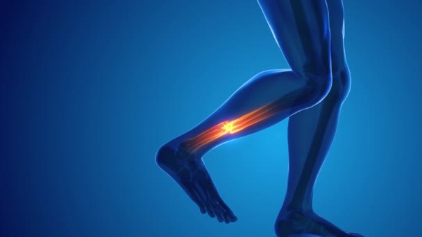 Broken Leg Bone Pain Medical Concept — Video Stock