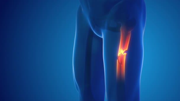 Broken Leg Femur Bone Pain Medical Concept — Wideo stockowe