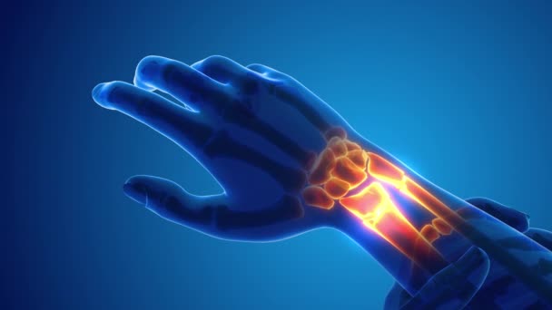 Broken Wrist Bone Pain Medical Concept — 图库视频影像