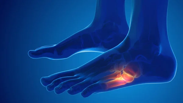 Broken foot bone pain medical concept