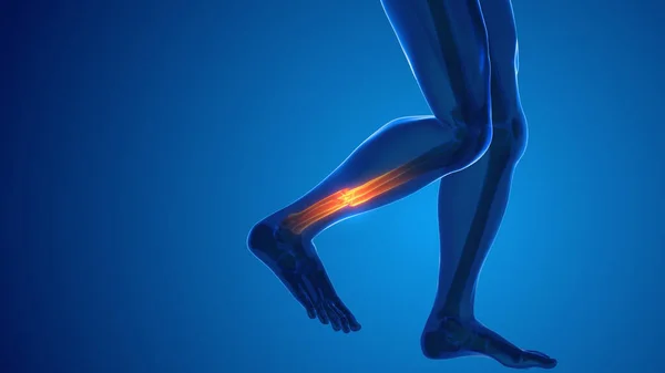Broken leg bone pain medical concept