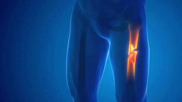 Broken leg Femur bone pain medical concept