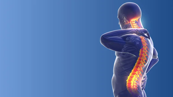Schmerzen Nacken Und Rücken Medizinischer Hintergrund — Stockfoto